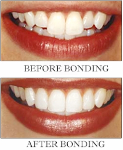 dental boding